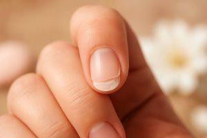 ongles dédoublés